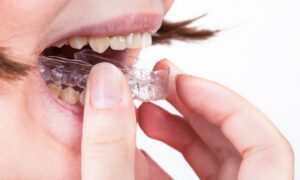 How the Orthodontist You Choose Can Make or Break Your Clear Aligner Treatment