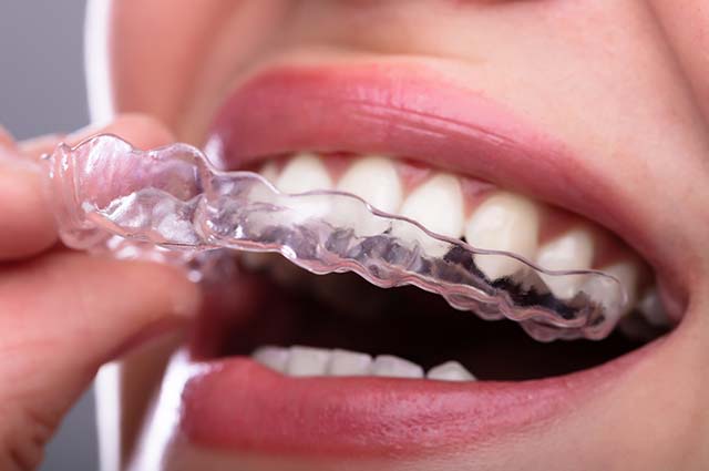 Clear Aligners - Braces for Teens and Adults in Rockford & Grand Rapids MI - Heinz Orthodontics