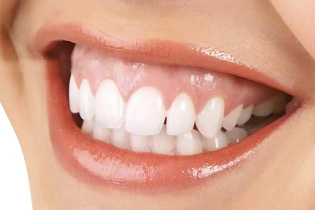 Gummy Smile Treatment (Gingivectomy) - Heinz Orthodontics - Rockford & Grand Rapids MI
