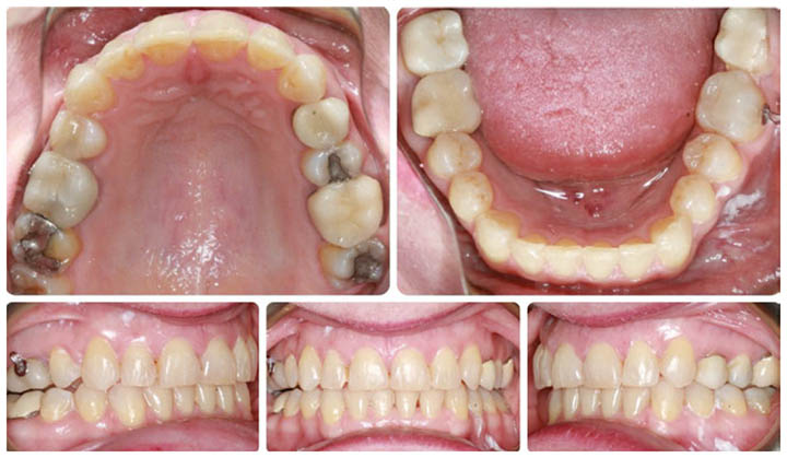 Spark Clear Aligners Case Study - Heinz Orthodontics - Rockford & Grand Rapids MI