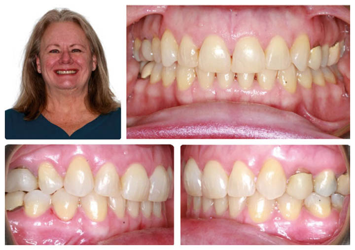 Spark Clear Aligners Case Study - Heinz Orthodontics - Rockford & Grand Rapids MI