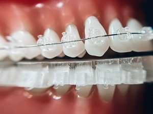 Lightforce Braces in Rockford & Grand Rapids MI - Heinz Orthodontics