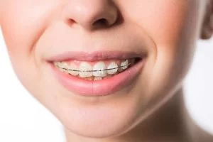 Adulting in Invisalign: Why Adult Orthodontics is More Popular Than Ever