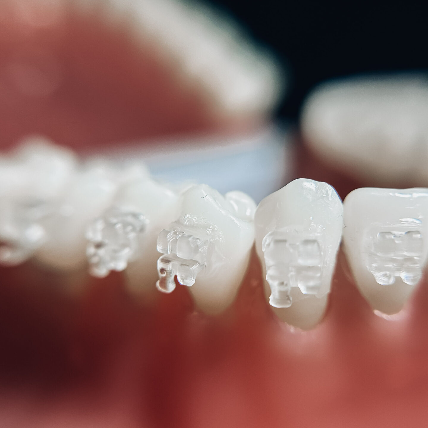 Clear Braces